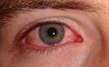 Conjuntivitis