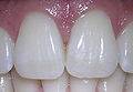 Blanqueamiento casero de dientes