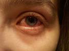 inflamacion de ojos